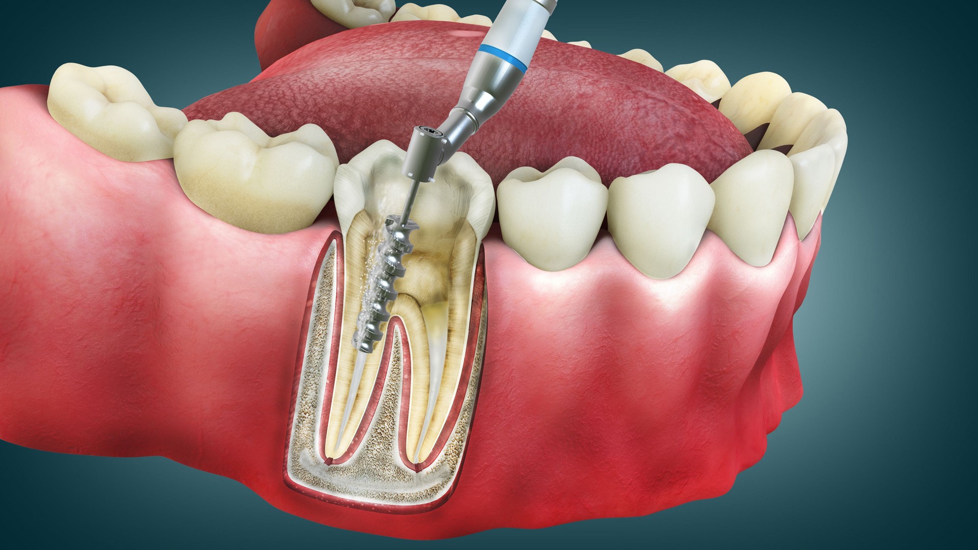 Painless root canal therapy in Ranjit Avenue Amritsar
