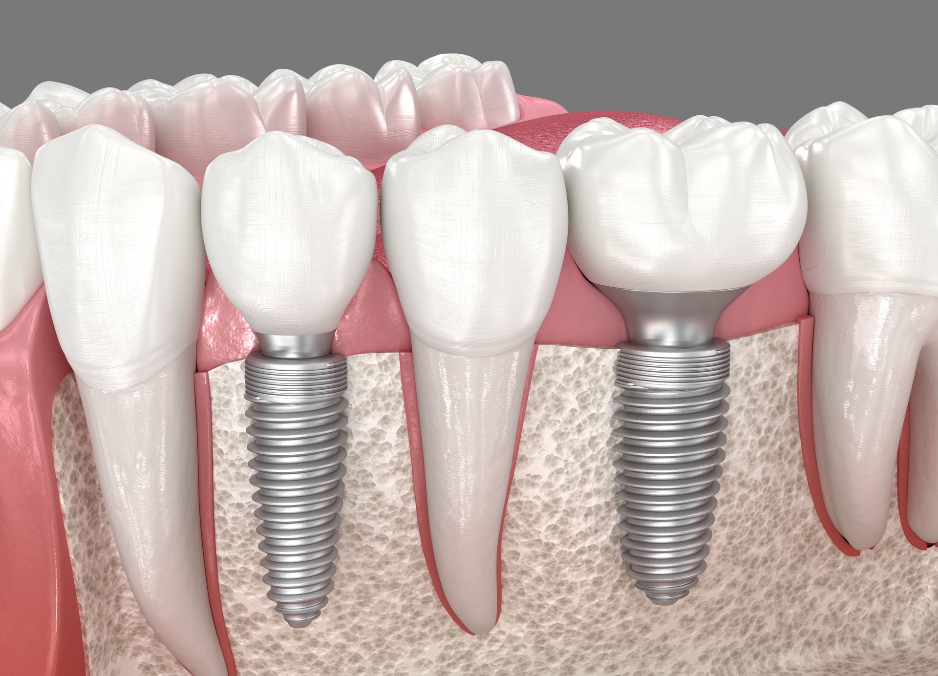 Dental Implant in Amritsar